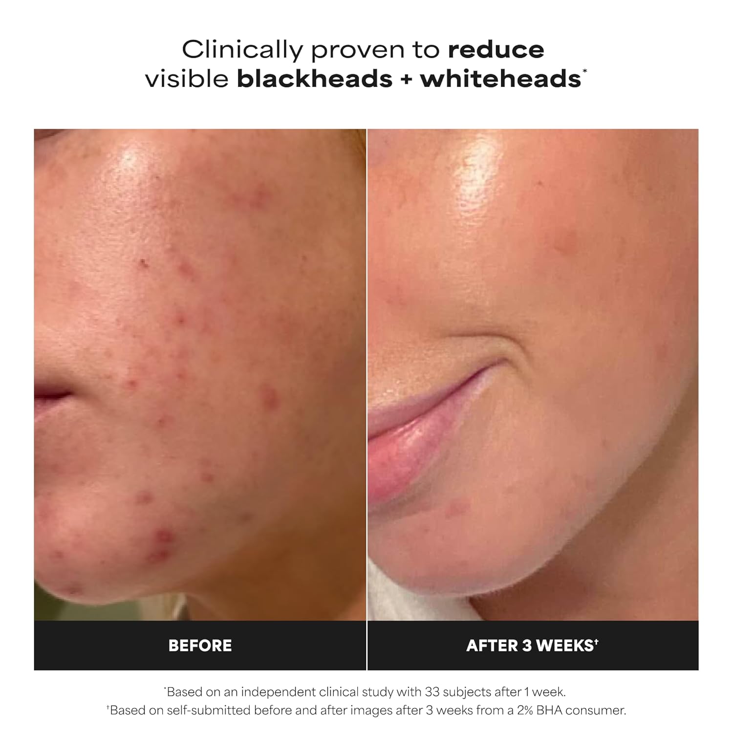 2% BHA Liquid Exfoliant For Smooth, Clear-Looking Skin