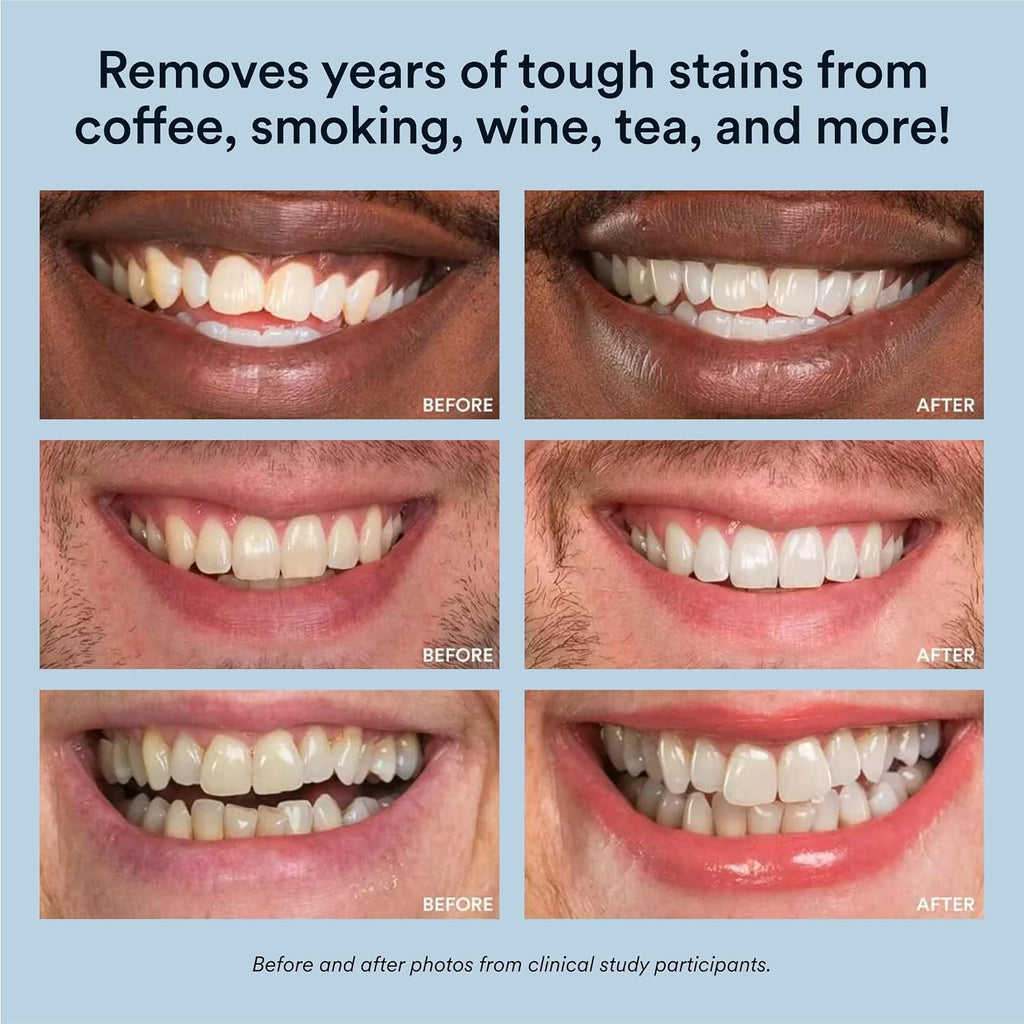 LED Teeth Whitening Kit With 35% Carbamide Peroxide Gel
