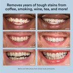 LED Teeth Whitening Kit With 35% Carbamide Peroxide Gel