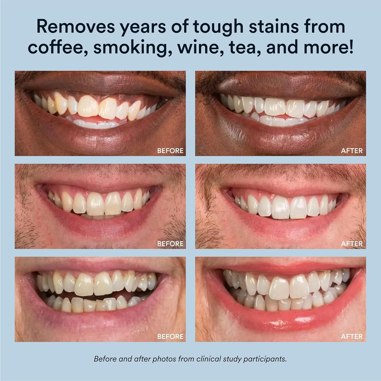 LED Teeth Whitening Kit With 35% Carbamide Peroxide Gel