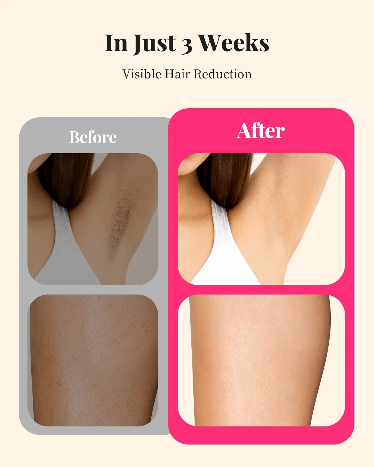 IPL Laser Hair Removal Device – Fast, Nearly Painless
